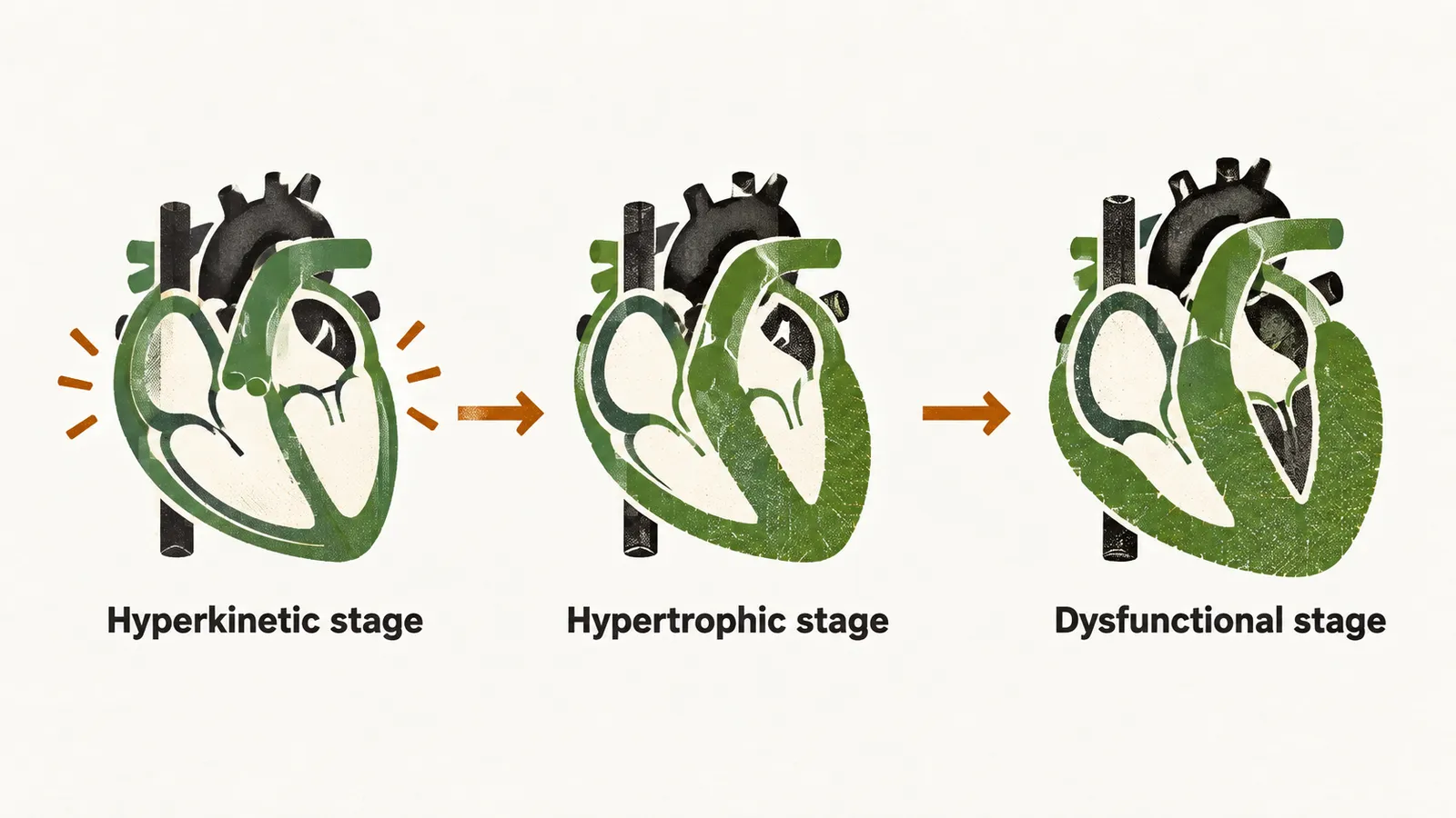 Three symbolic hearts in a row show acromegalic cardiomyopathy progressing from a hyperkinetic stage through hypertrophy to the dysfunctional stage.