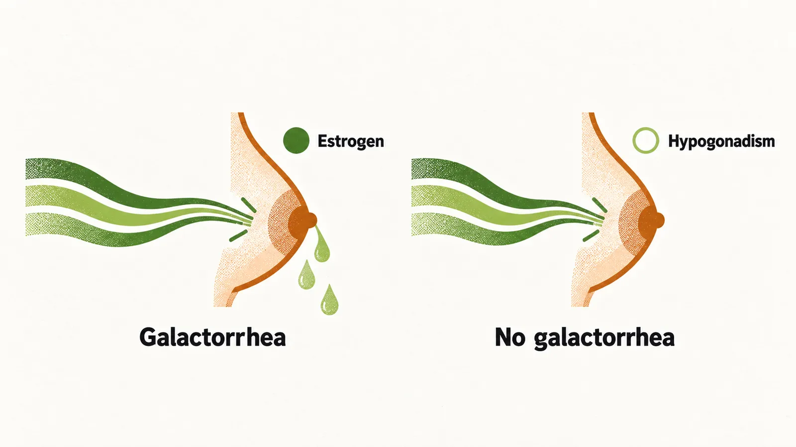 Two panels show that with an estrogen dot present a breast releases milk droplets under a prolactin stream, and with the dot faded in hypogonadism no droplets appear.