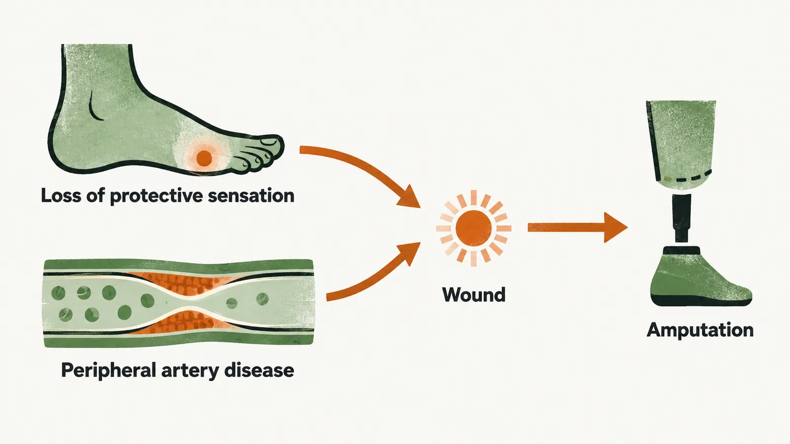 Two causes, loss of protective sensation and peripheral artery disease, converge on a wound that fails to heal and can lead to amputation.