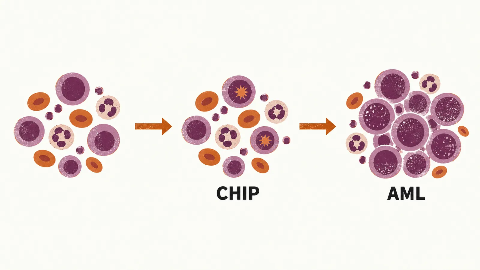 Three marrow stages joined by arrows, from a normal mixed marrow to a marrow with a few first-mutation cells labelled CHIP, to a marrow crowded by blasts labelled AML.