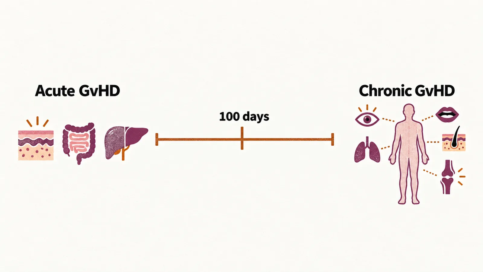 A timeline split at a 100 days marker, an acute GvHD panel at the left with skin, gut and liver icons, and a chronic GvHD panel at the right.