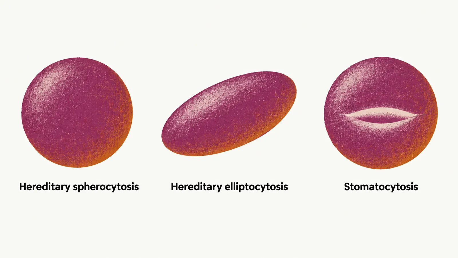 Three red-cell shapes on paper: a round spherocyte, an elongated elliptocyte and a mouth-shaped stomatocyte, each labelled.