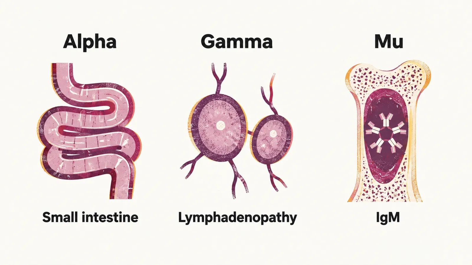 Three columns comparing alpha, gamma and mu heavy chain disease, showing the small bowel, lymph nodes and an IgM-linked marrow picture.
