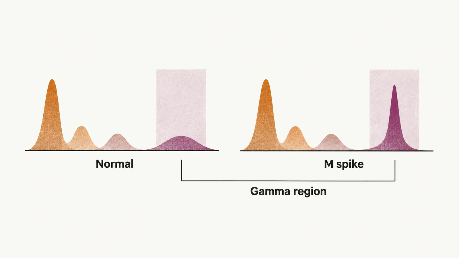 Two electrophoresis strips side by side, a low broad hump in the gamma region and a tall narrow sharp peak.