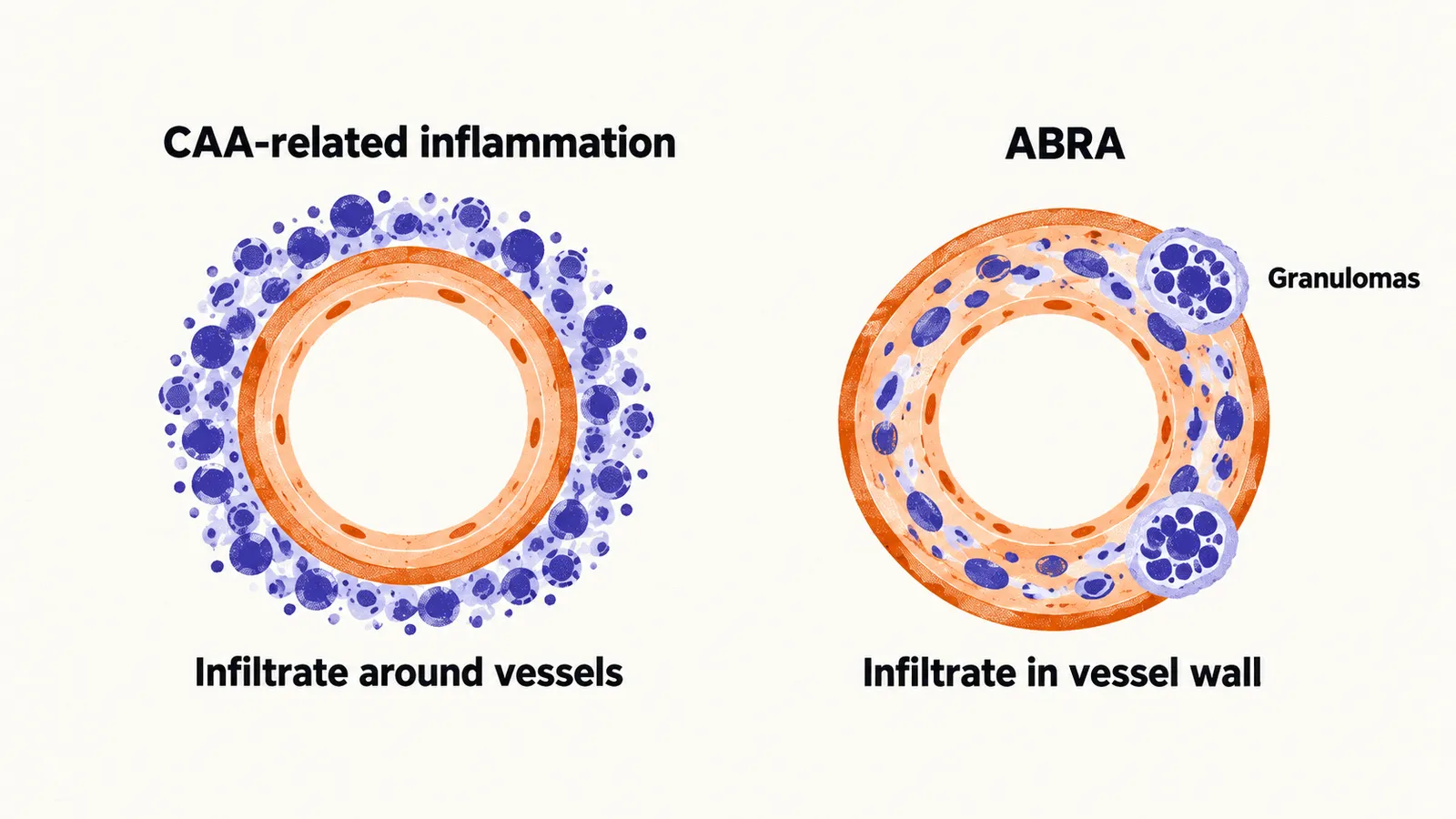 Two vessels compared, infiltrate gathered around one vessel wall, and infiltrate invading the other wall with granulomas.