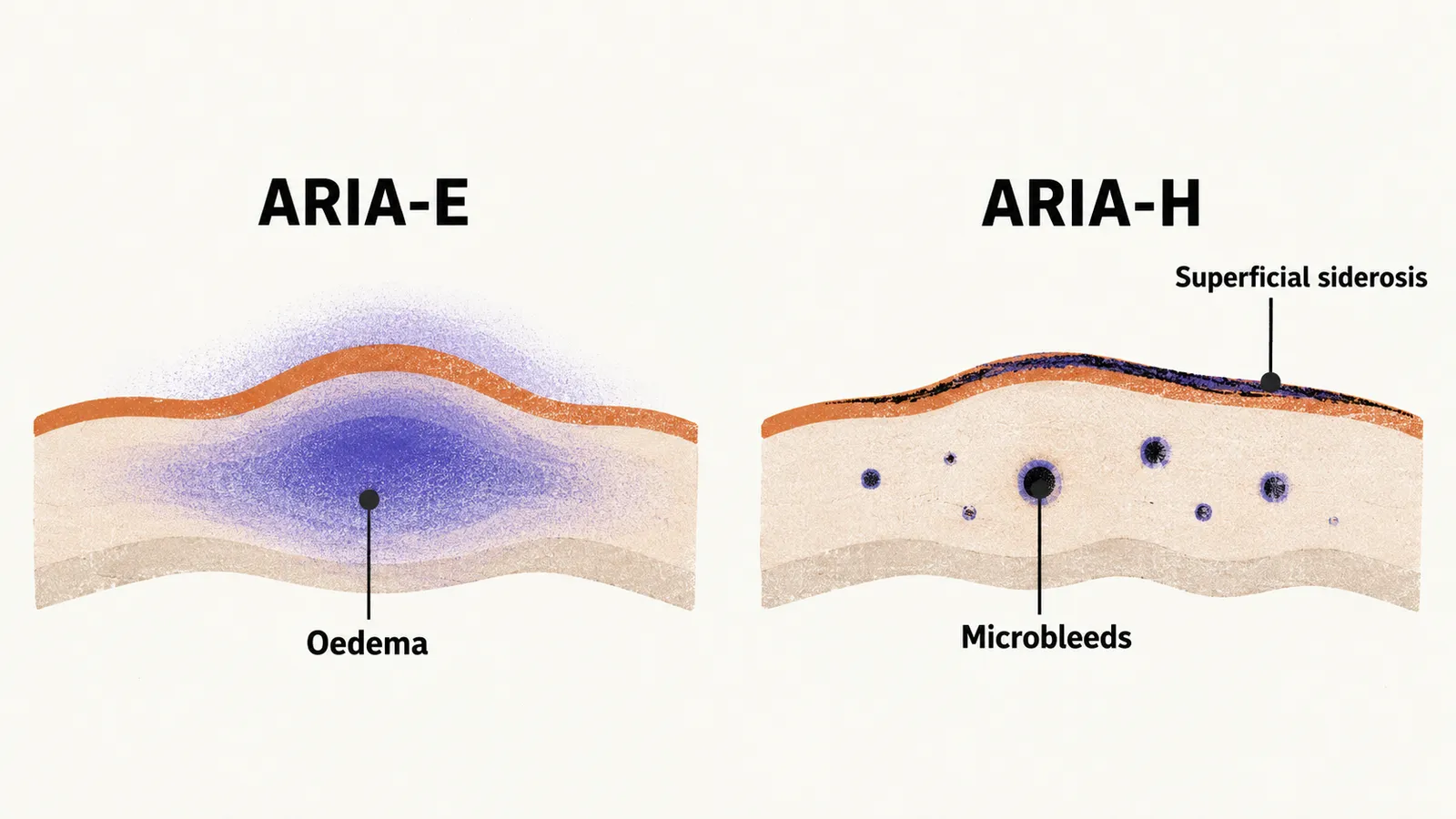Two panels, a swelling oedema in cortex for ARIA-E, and microbleeds with a superficial siderosis line for ARIA-H.