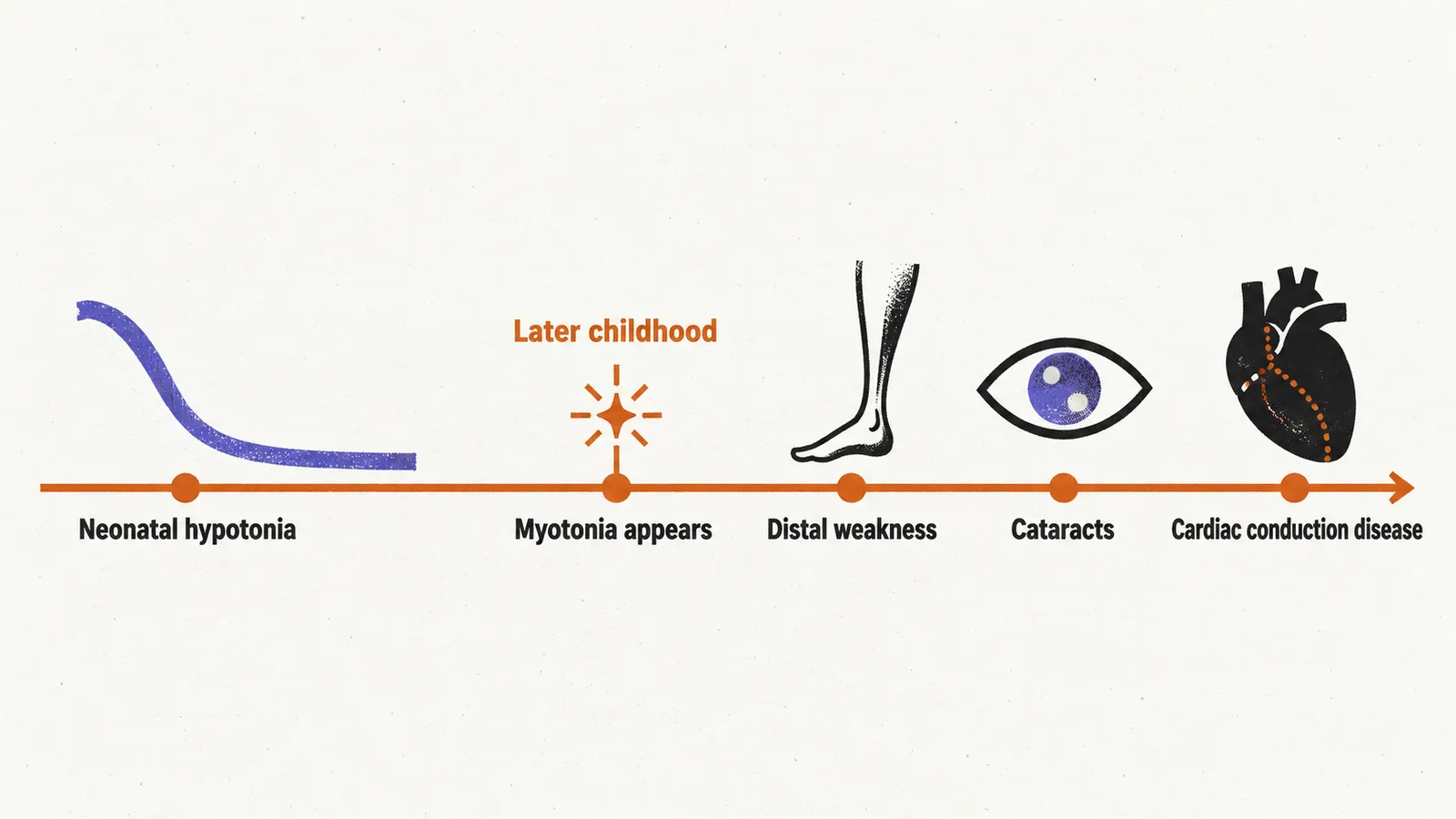 A left to right timeline with a slack curve, a spark, then a weakening limb, an eye and a heart with a dotted line, labelled from Neonatal hypotonia to Cardiac conduction disease.