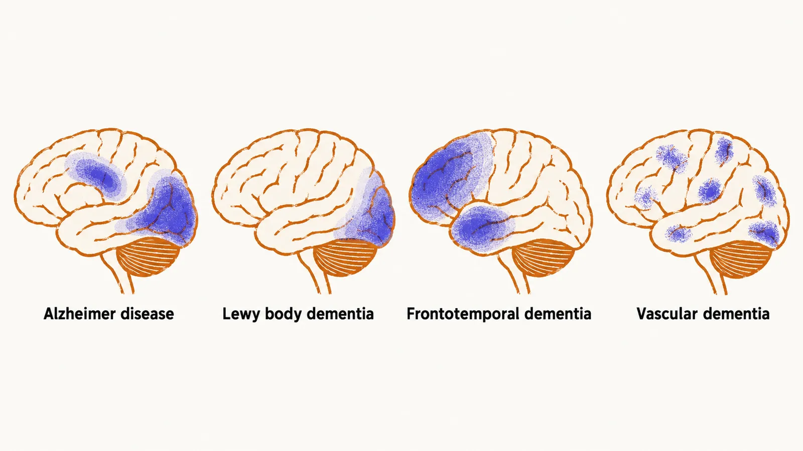 Four brain profiles in a row, each shaded in a different region: posterior and temporoparietal, occipital, frontal and anterior temporal, then patchy asymmetric areas.