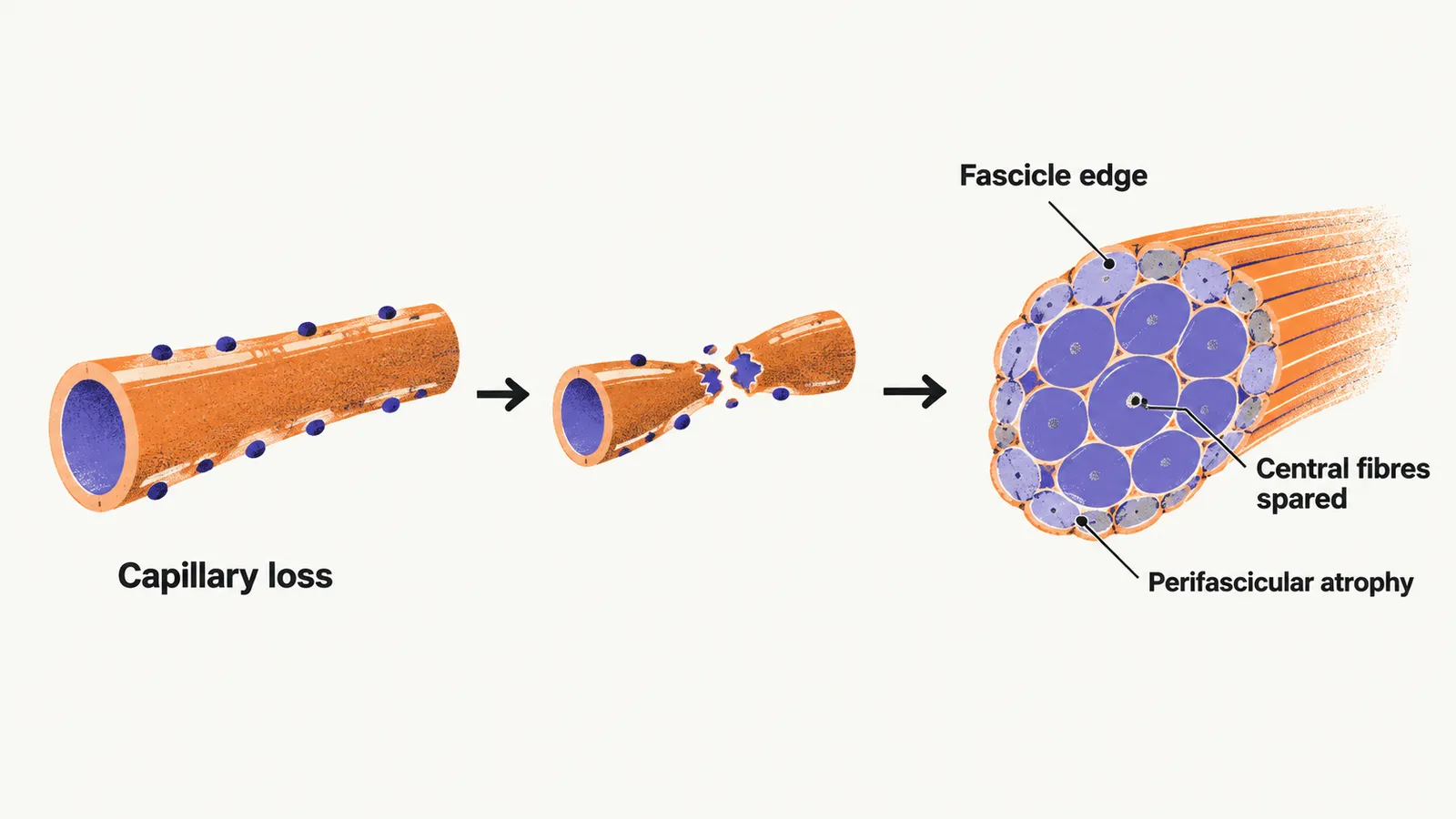 A pathway from a deposit-marked capillary that narrows and breaks to a muscle bundle whose edge fibres are shrunken while central fibres stay unchanged.