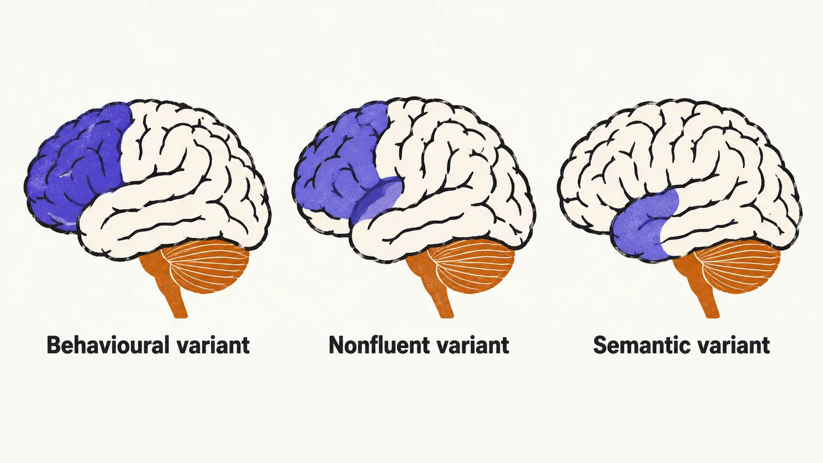 Three brain profiles in a row, shaded in the frontal region, then the left frontal and insular region, then the anterior temporal region.