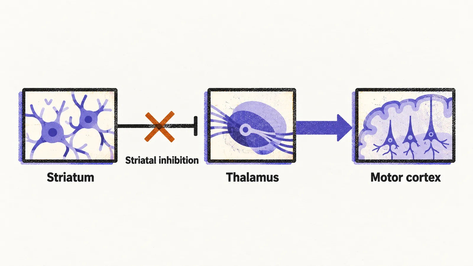 Three boxes labelled Striatum, Thalamus and Motor cortex joined by arrows, the inhibitory striatum to thalamus arrow crossed out and a thickened thalamus to motor cortex arrow.