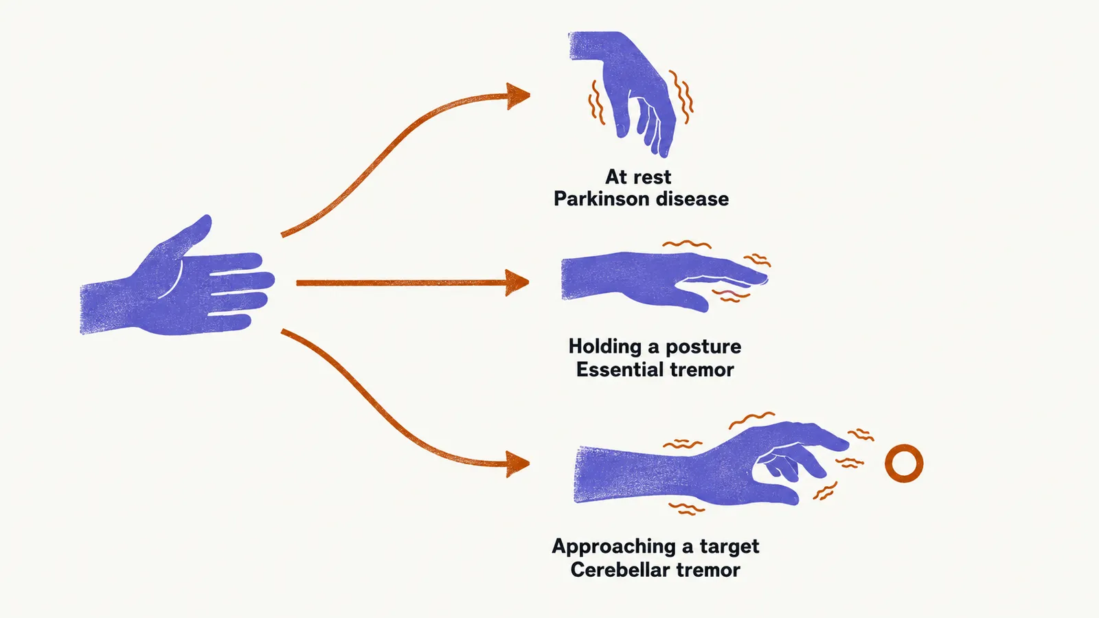 A hand at the left branches by three arrows to a resting hand, a hand held out and a hand reaching a target ring, each with the tremor pattern it suggests.