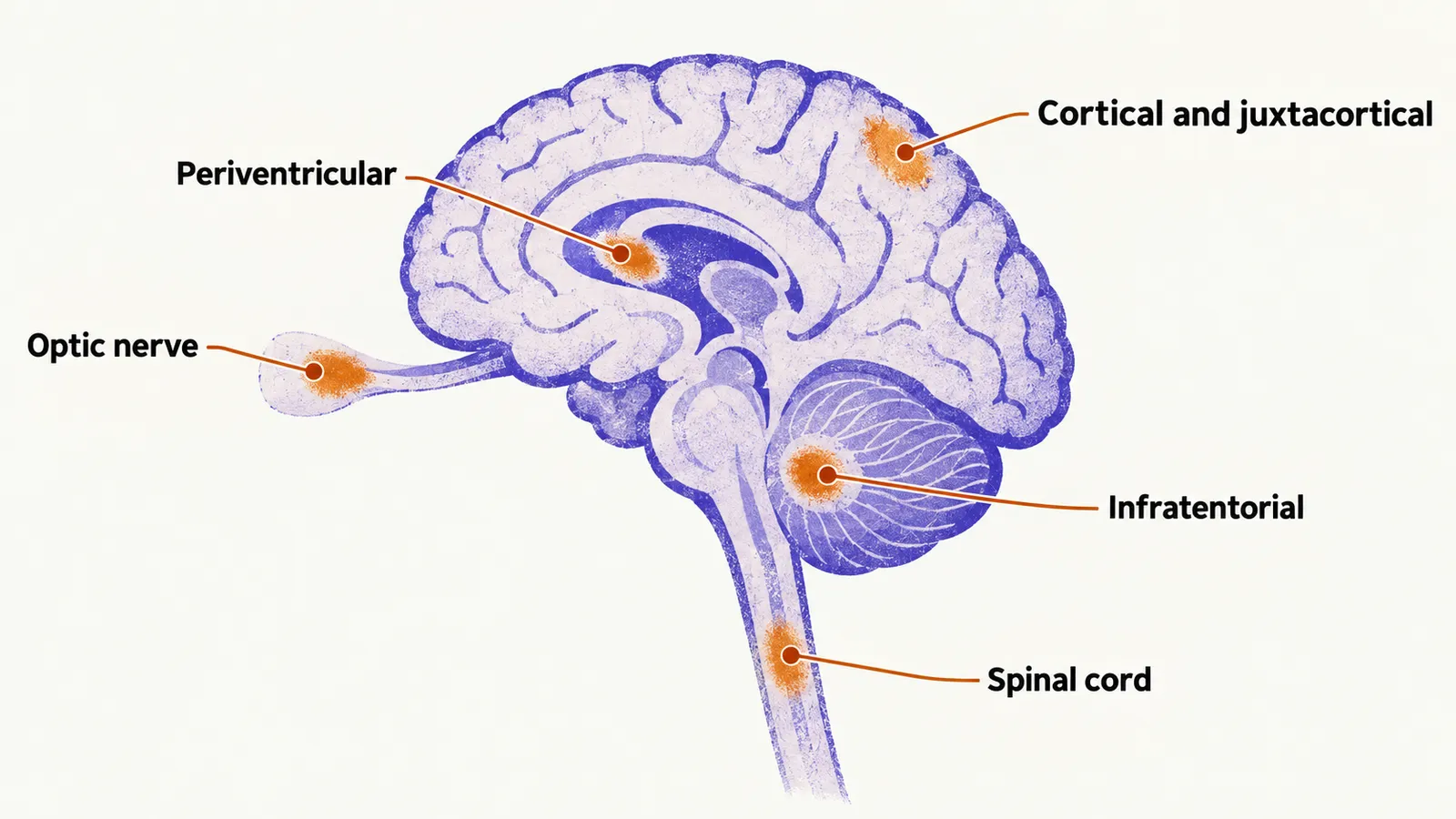 A simple brain and spinal cord outline marks the five lesion sites, periventricular, cortical and juxtacortical, infratentorial, spinal cord and optic nerve.