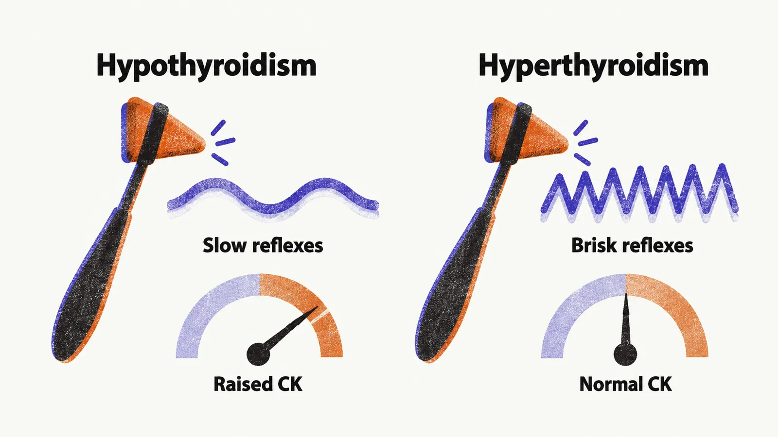 Two panels side by side for hypothyroidism and hyperthyroidism, each pairing a reflex hammer with a slow or brisk line and a dial for raised or normal CK.