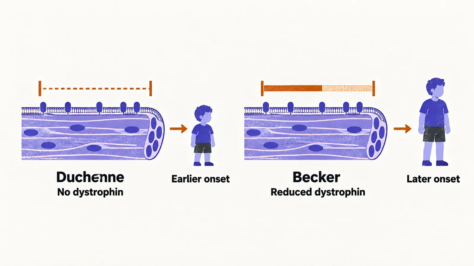 Two panels of a muscle-fibre edge, one with no dystrophin bracket and an earlier onset, the other with a reduced bracket and a later onset.