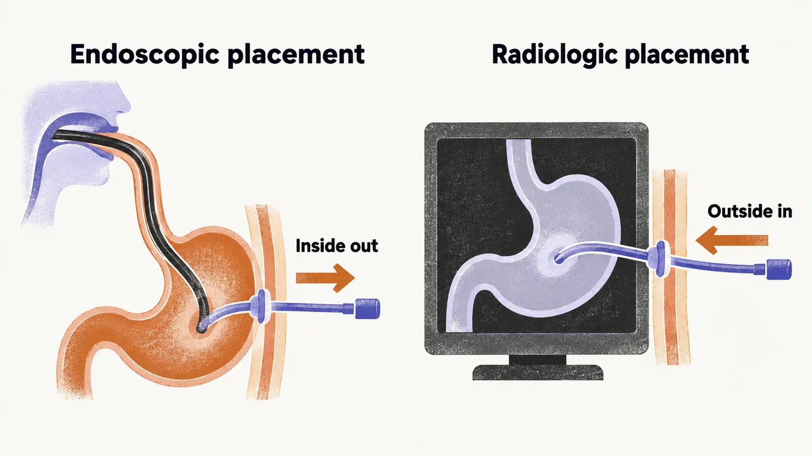 Two panels compare the feeding-tube routes, one placing the tube from inside out endoscopically and one from outside in under imaging.