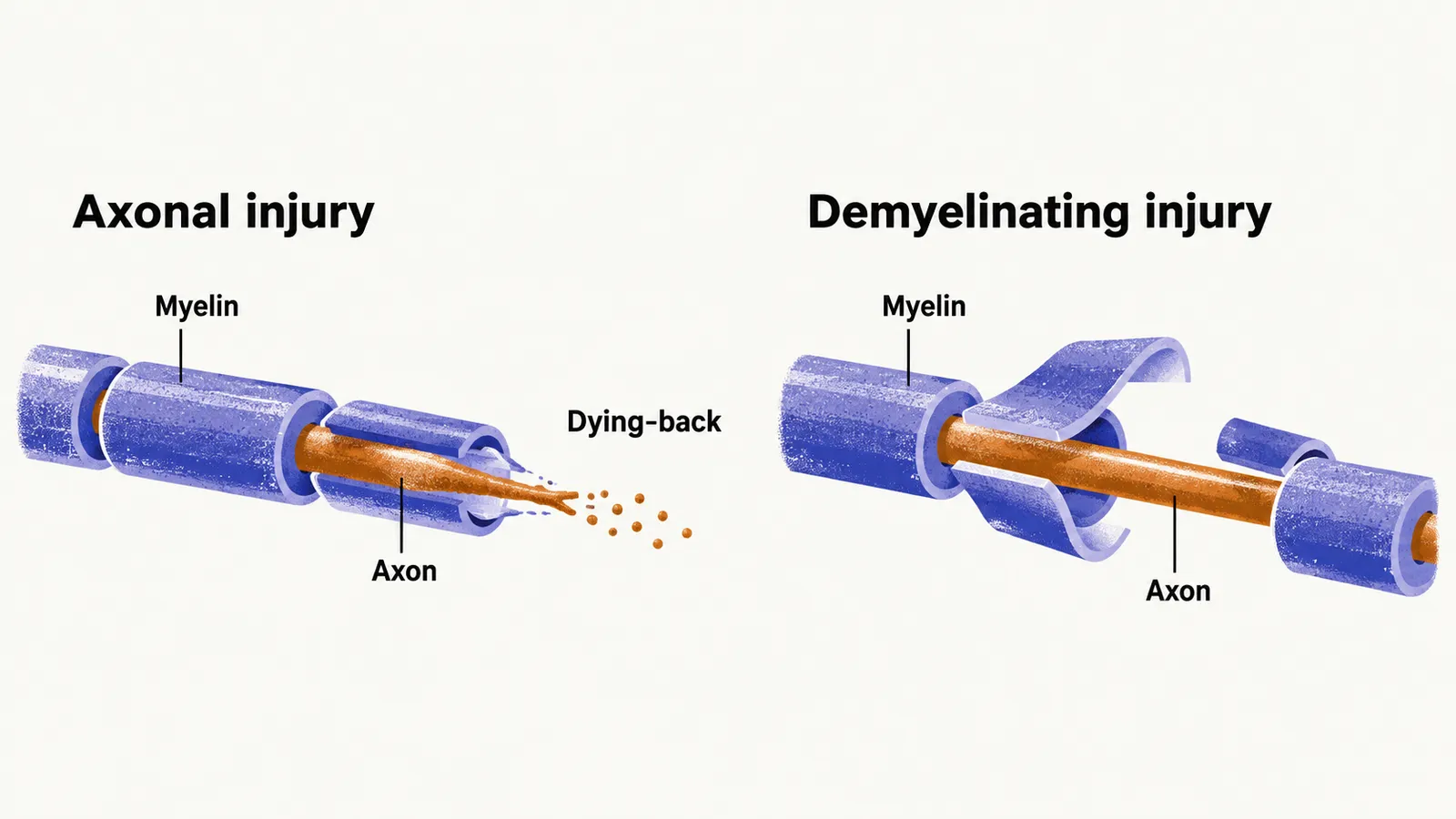 Two nerve fibres side by side, one with an intact sheath and a fraying axon labelled axonal injury, the other with its sheath peeling away from an intact axon.