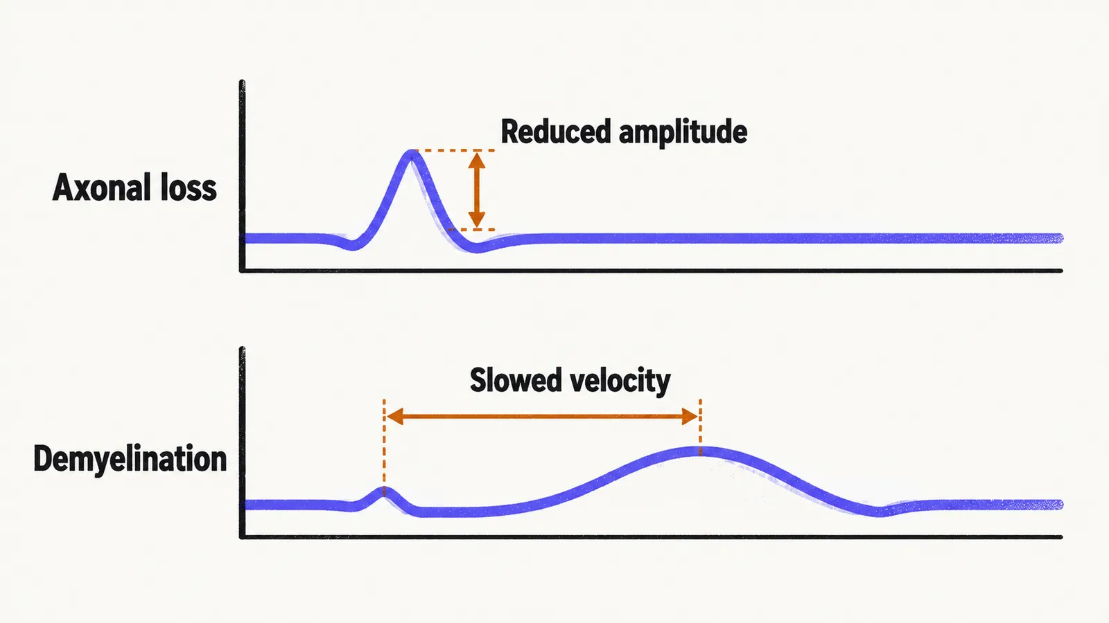 Two waveform traces, one with a reduced amplitude for axonal loss and one with a slowed, delayed broad peak for demyelination.