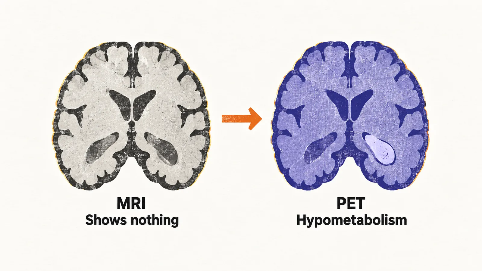 Two brain slices side by side: a plain faint MRI slice showing nothing, and an indigo PET slice with one pale hypometabolic region.