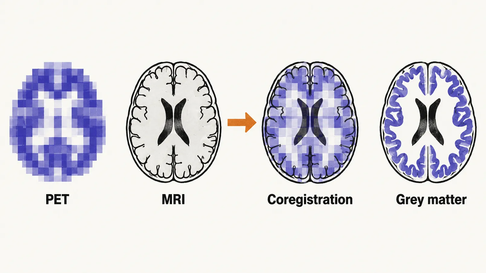 A coarse PET block and a sharp MRI slice slide together under a saffron alignment arrow, leading to a brain outline of grey matter.