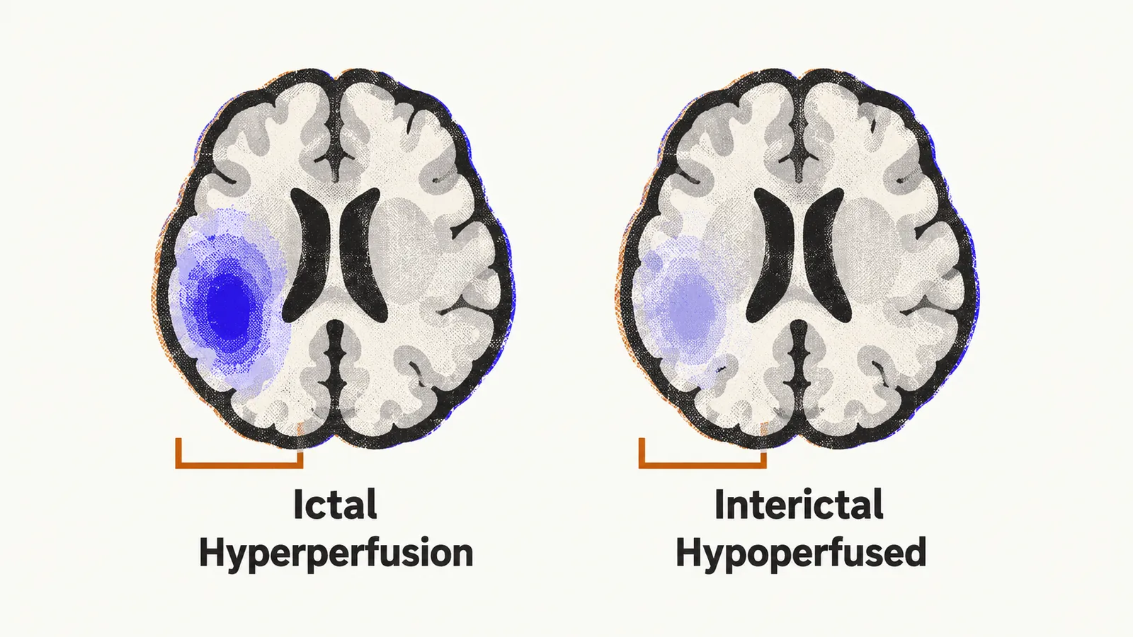 Two brain slices show the same region flaring bright indigo in the ictal state and running pale and cool in the interictal state.