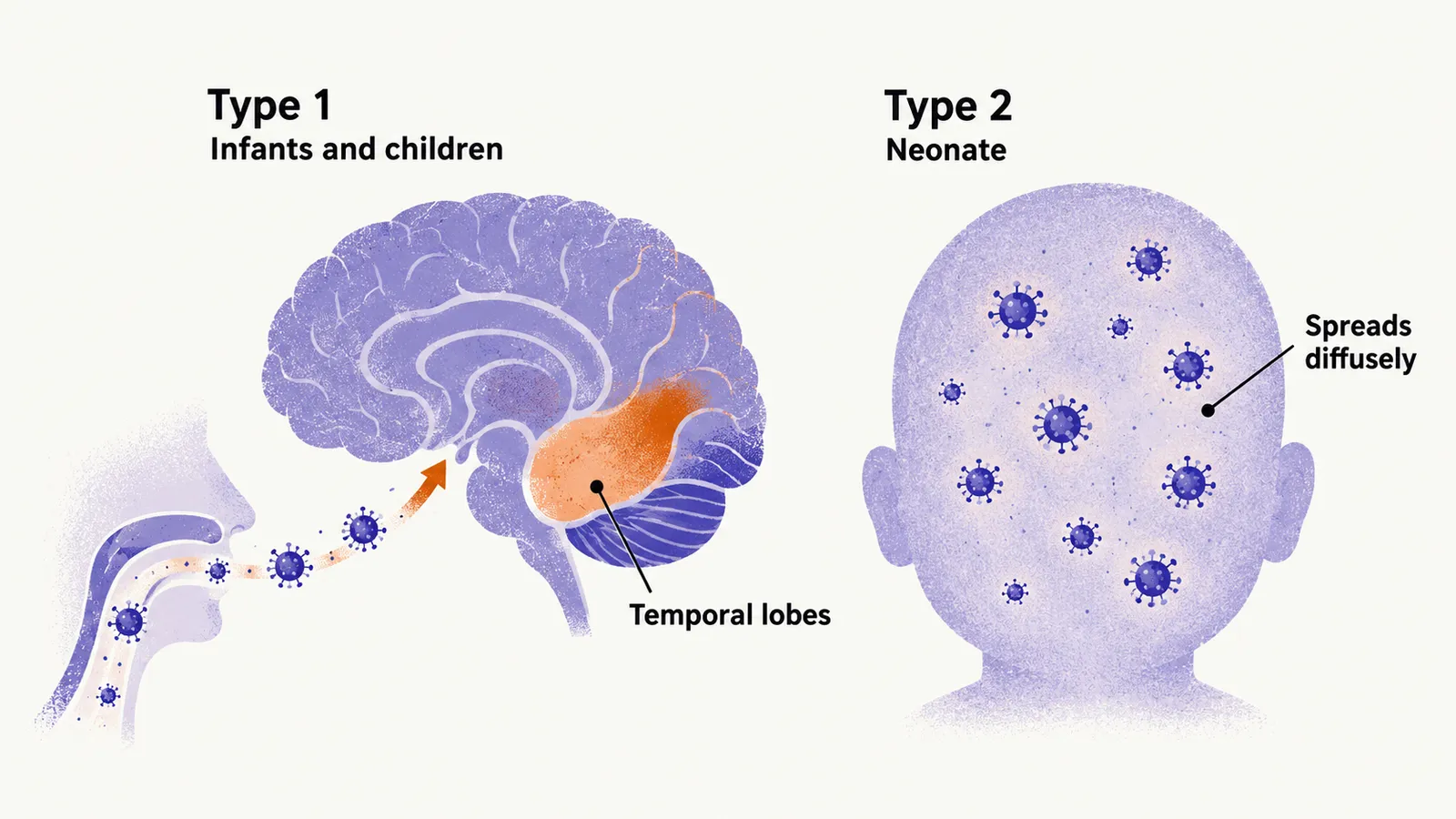 Two panels: type 1 in infants and children with virus reaching the temporal lobes, and type 2 in the neonate spreading diffusely across the brain.