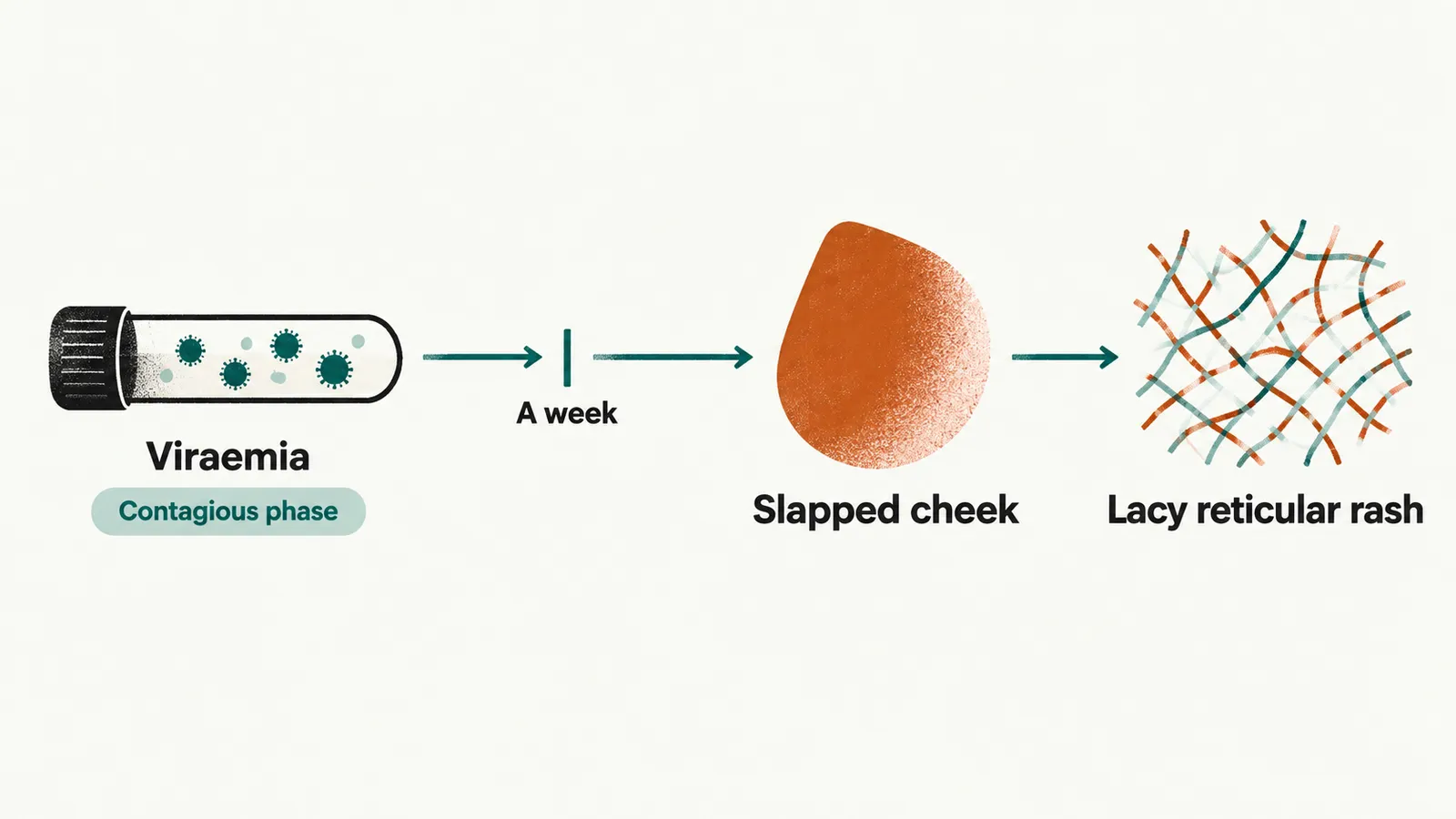 Timeline on cream paper. A tube of particles, Viraemia, tagged Contagious phase; a tick tagged A week; a cheek shape tagged Slapped cheek; a net of fine lines tagged Lacy reticular rash.