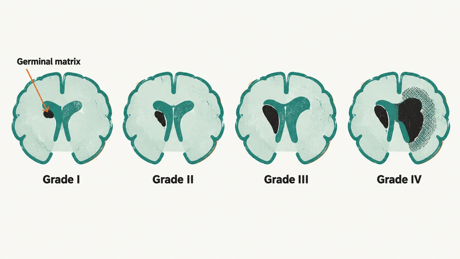 Four brain outlines in a row showing grades I to IV, with dark pooling spreading from the germinal matrix into a ventricle that dilates and then into surrounding tissue.